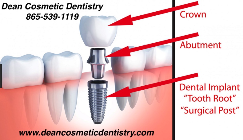 健康・医学 Implant Dentistry: Theory and Practice Best Practices in Implant Dentistry: 9781394199648: Medicine